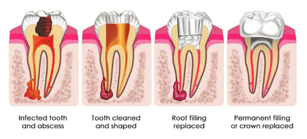 Root Canal Payment Plans | Root Canal Financing